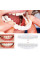 Знімні вініри Veneers  smile
